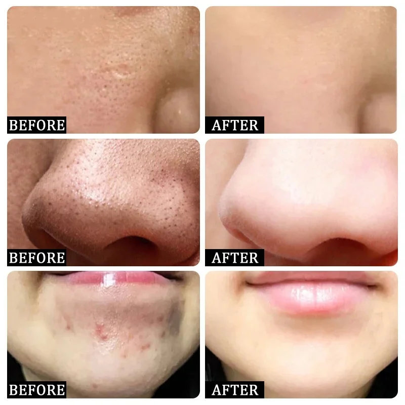 Salicylsäure Poren Clearing Cr – Korean Lifestyle Products Bewertung und Preis